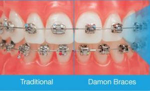 Damon Braces