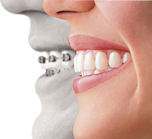 invisalign-teen