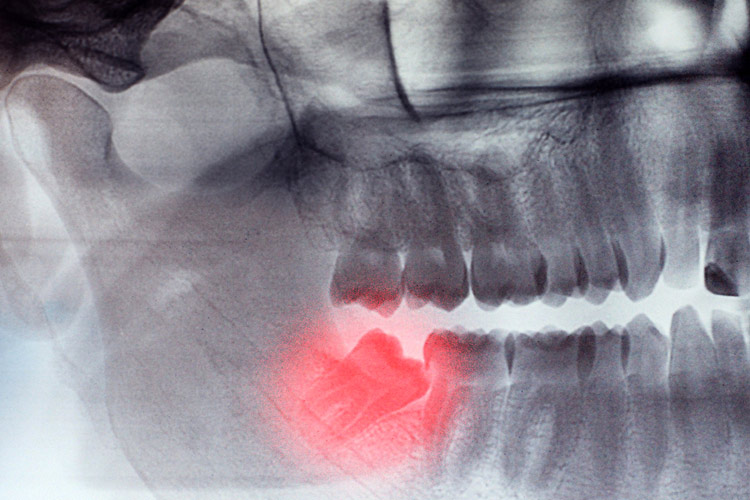 Holiday Savings - Receive 15% off Wisdom Teeth Extractions