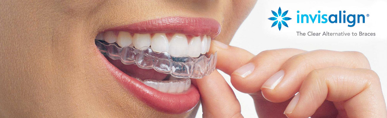 invisalign braces