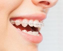 Ceramic Braces