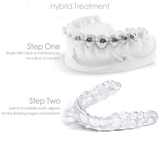 Hybrid Braces