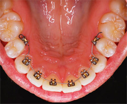 Lingual Braces