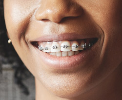 Metal Braces