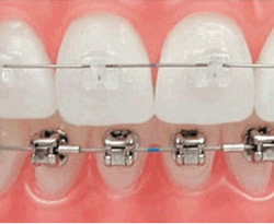 Self-Ligating Braces