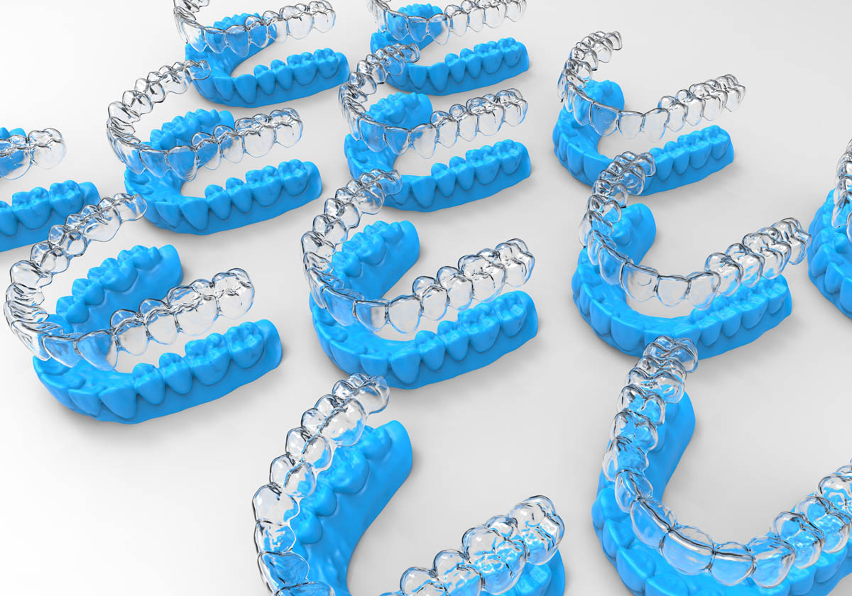 aligners - retainers