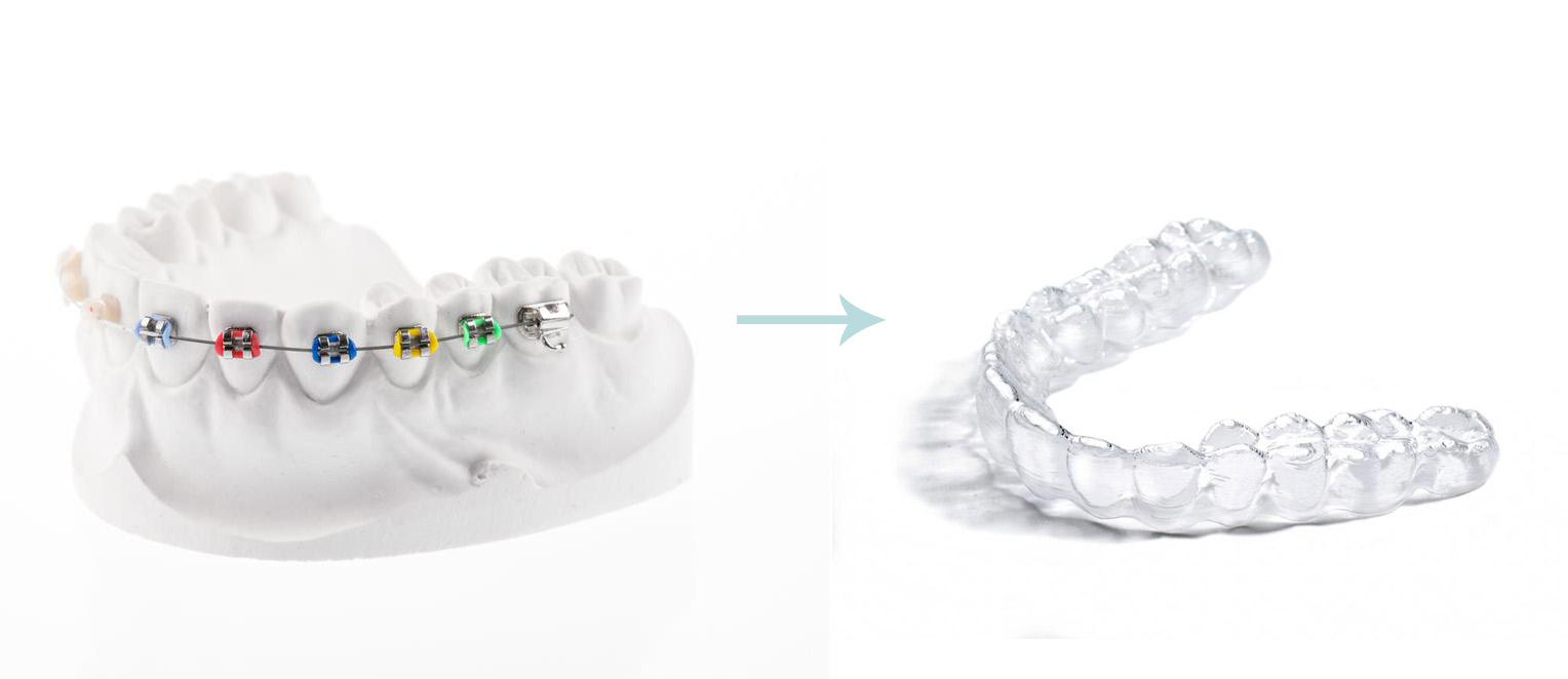 braces vs retainers