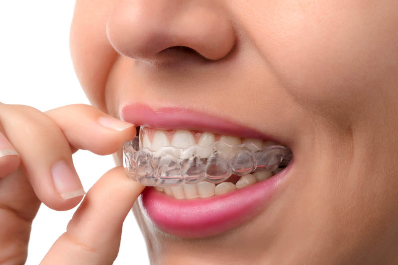 clear aligners