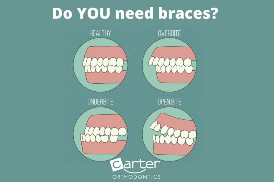 Do you need braces or aligners
