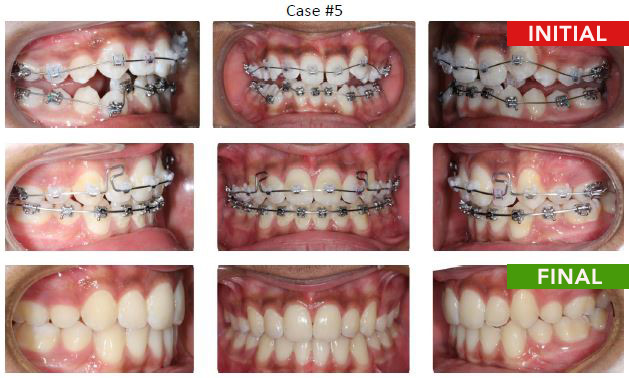 Braces Removal 10th appointment