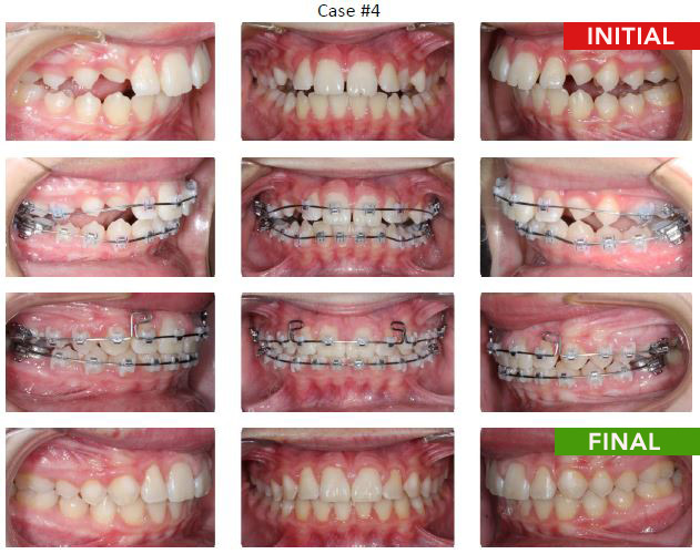 Braces Removal at 13 months