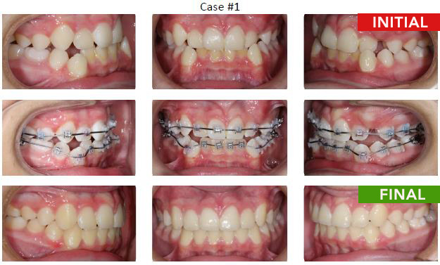 braces Removal at 52 weeks