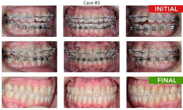 braces under bite - 11 months treatment