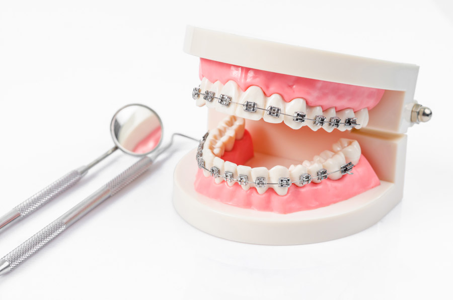 Traditional Braces Atlanta, GA, Self-Ligating Orthodontics