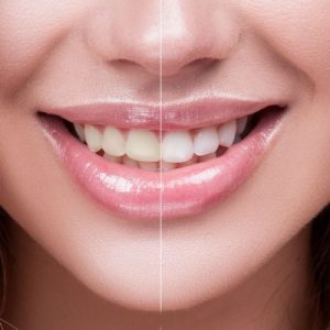 Teeth Whitening Before and After