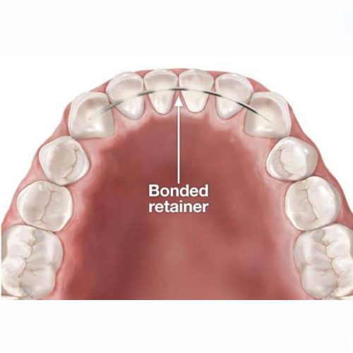 Spring Returner Spring Retainer - Carter Orthodontics