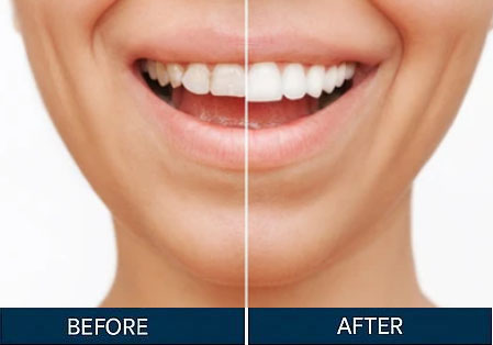Before & After
