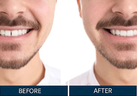 Before & After